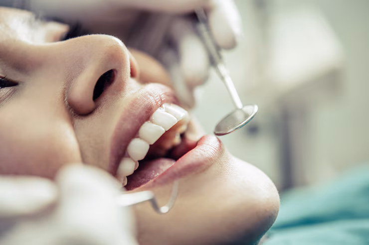 Composite Fillings Queens NY | Briarwood Dental Care