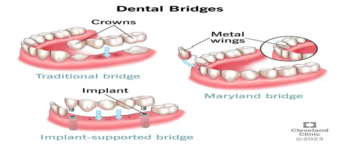 Dental Bridges Queens NY | Briarwood Dental Care