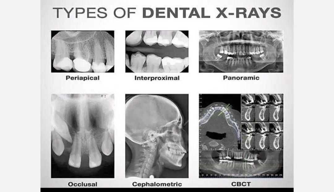 Dental X-Rays Queens NY | Briarwood Dental Care