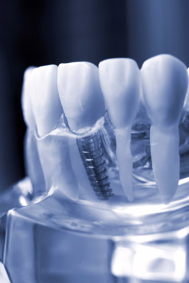 Dental Bridges Queens NY | Briarwood Dental Care