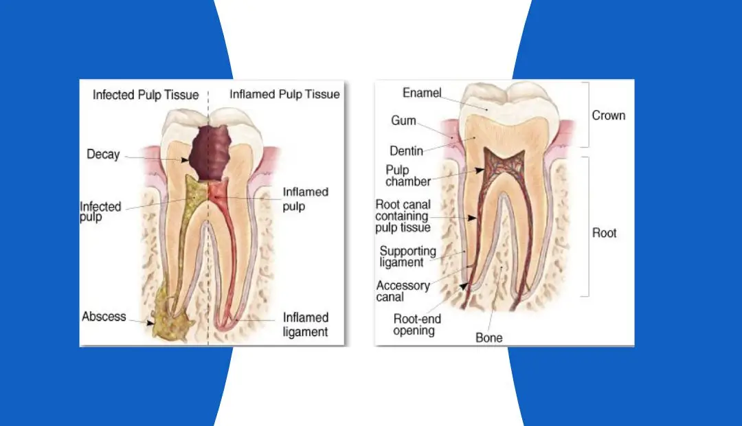 Root Canal Treatment Queens NY | Briarwood Dental Care