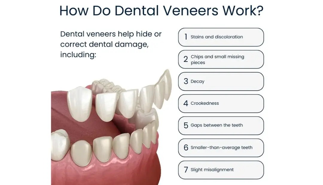 Dental Veneers Queens NY | Briarwood Dental Care